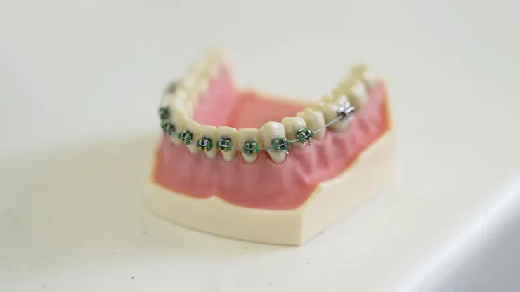 False set of lower teeth, covered by braces